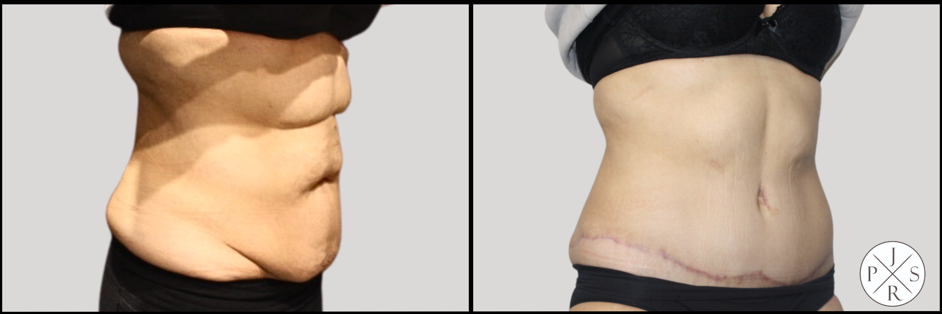 Abdominoplasty Before & After Image